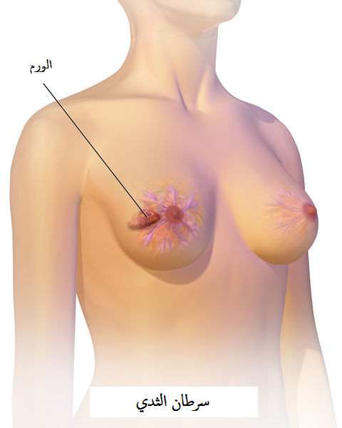 هل يظهر سرطان الثدي فجأة