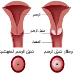 سرطان عنق الرحم