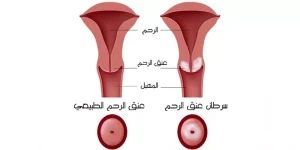 سرطان عنق الرحم