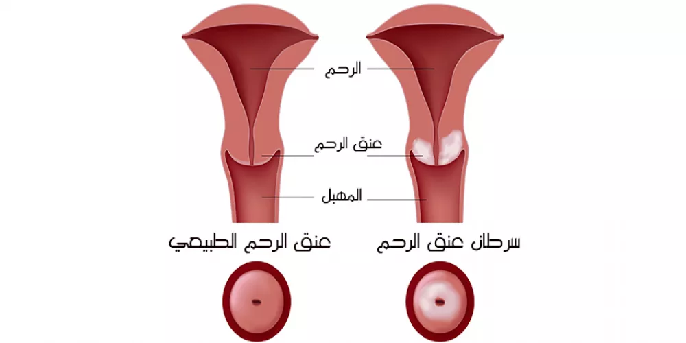 سرطان عنق الرحم